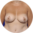 Breast reduction model 02, Ritz Plastic Surgery Melbourne