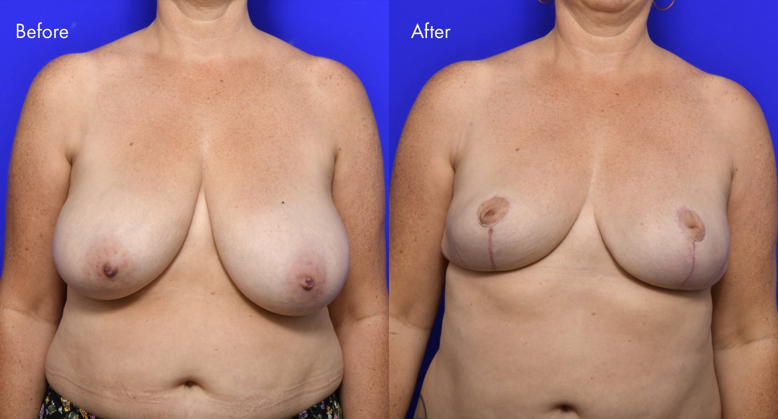 Breast Reduction Before and After | 8