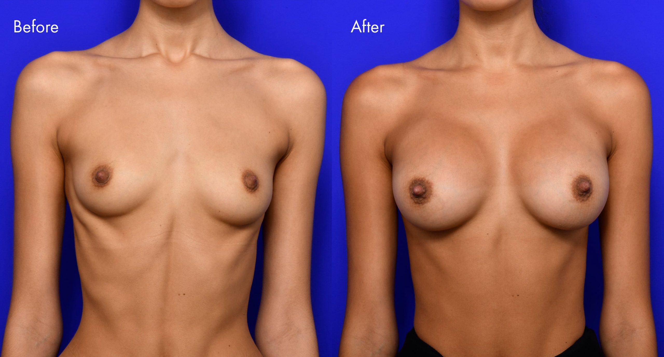 Breast Augmentation Before and After | 6