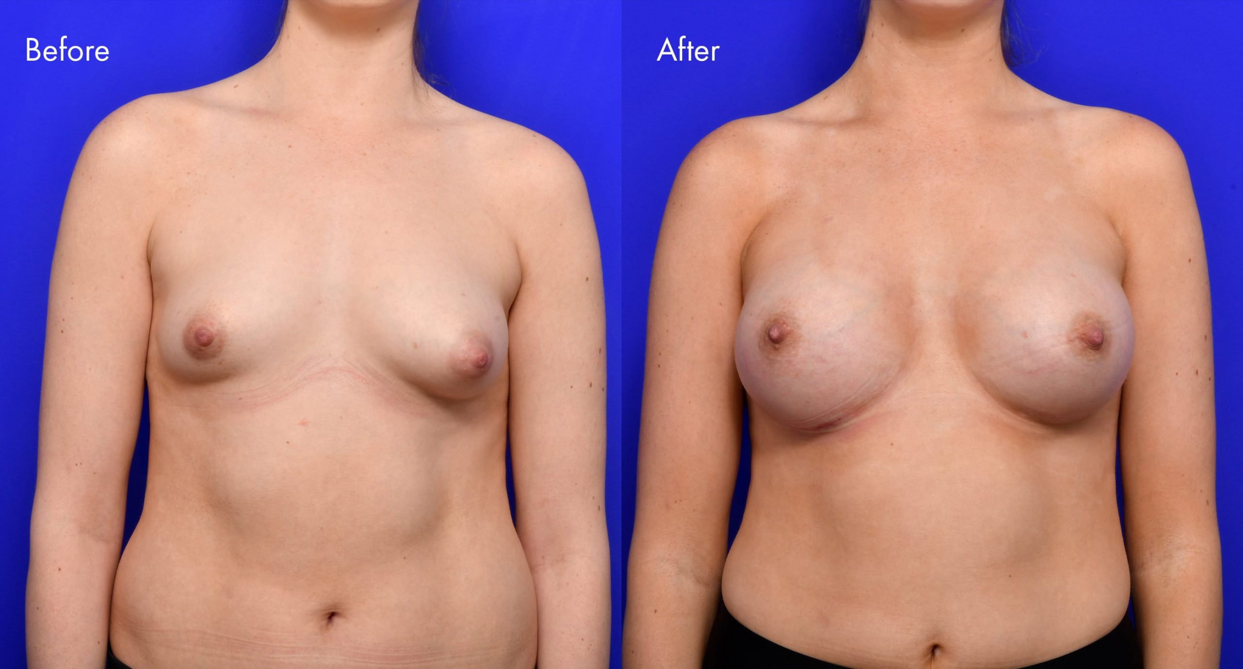 Tuberous Breasts Before and After | 1
