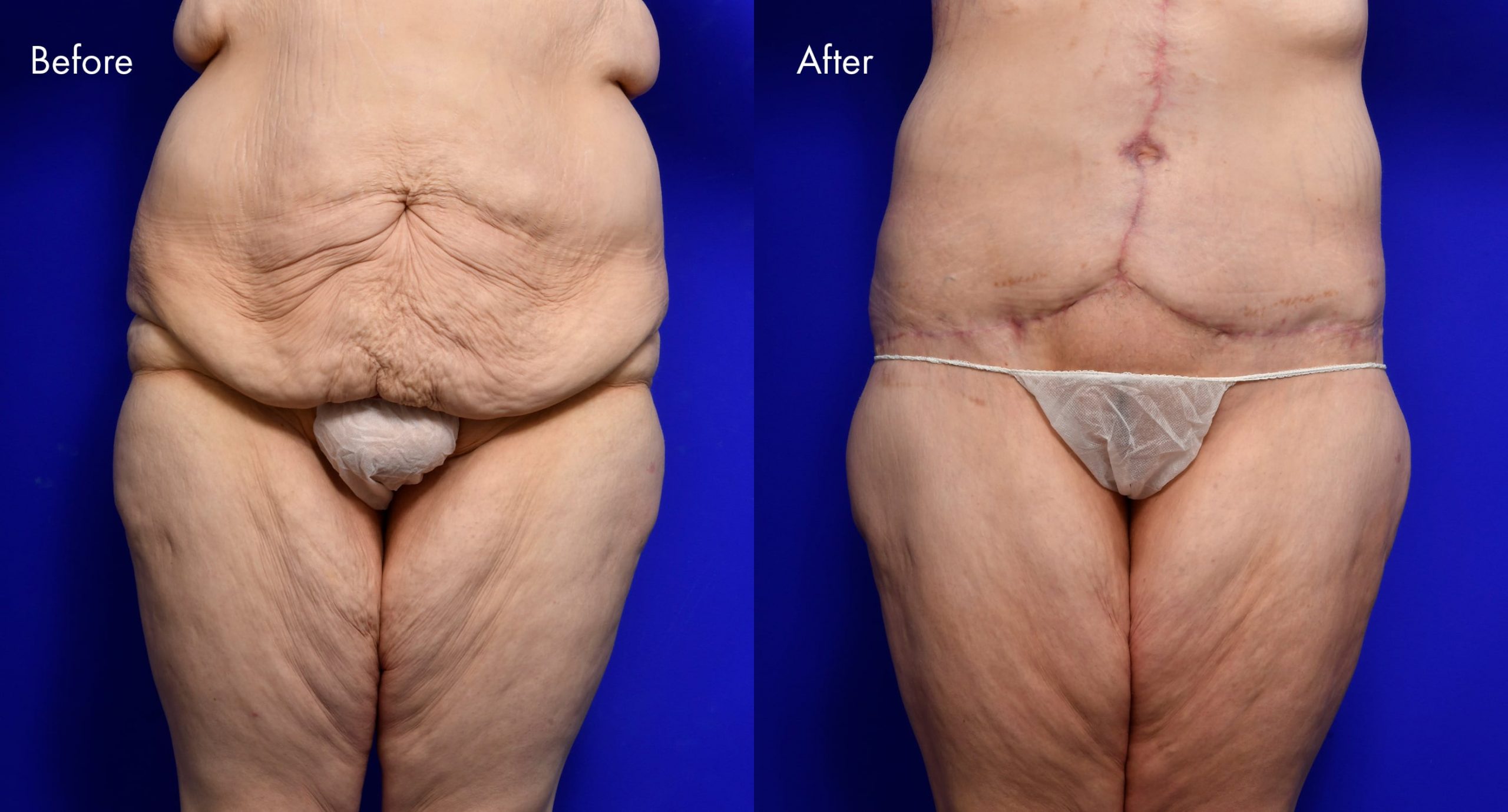 Tummy Tuck (Abdominoplasty) Before and After | 1