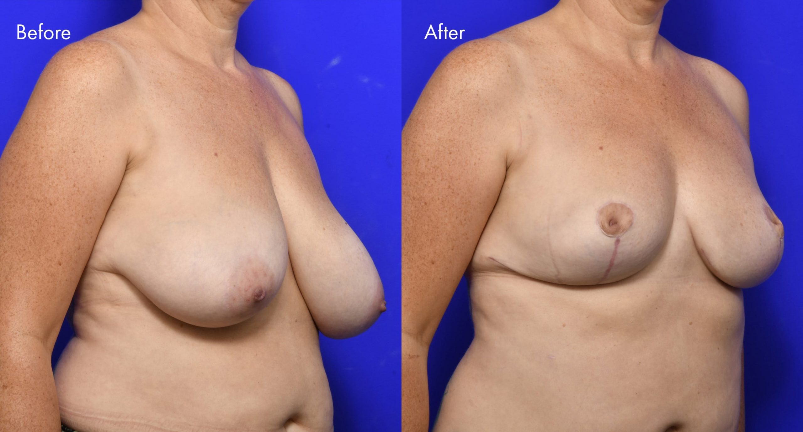 Breast Reduction Before and After | 12