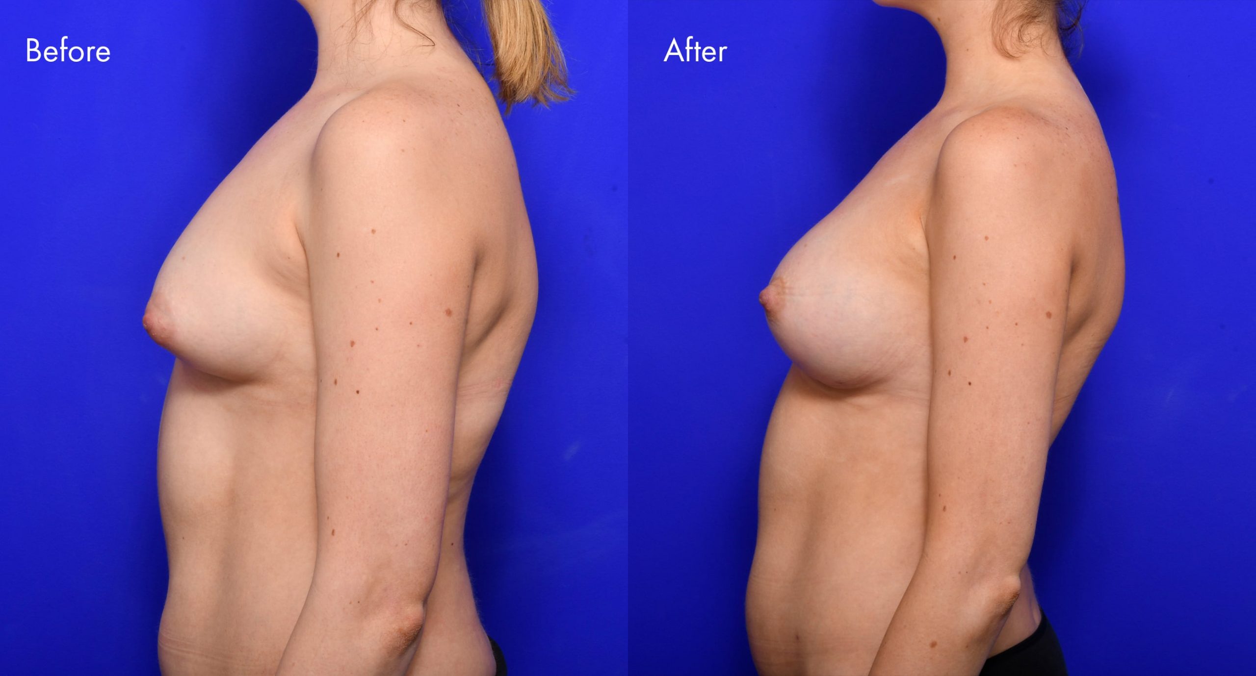Tuberous Breasts Before and After | 2