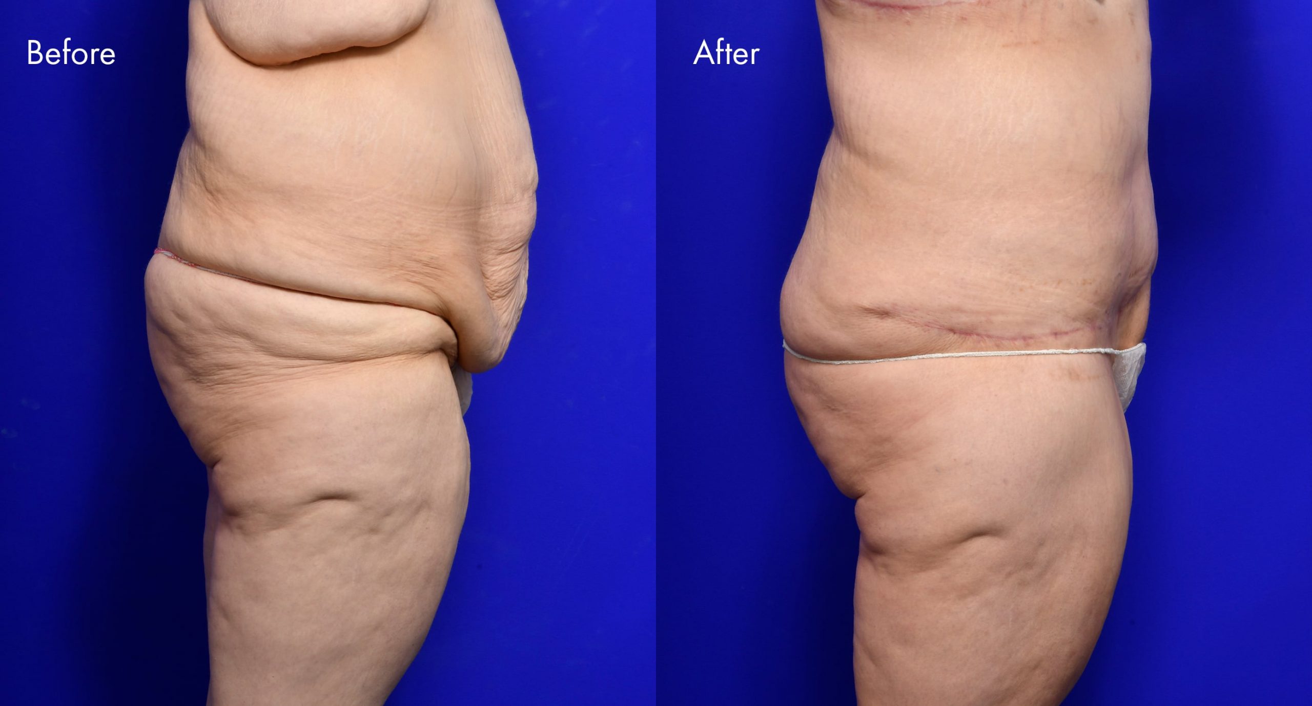 Tummy Tuck (Abdominoplasty) Before and After | 2