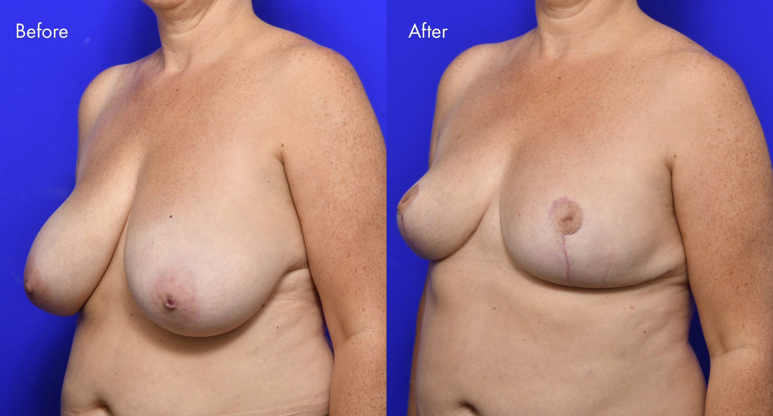 Breast Reduction Before and After | 11