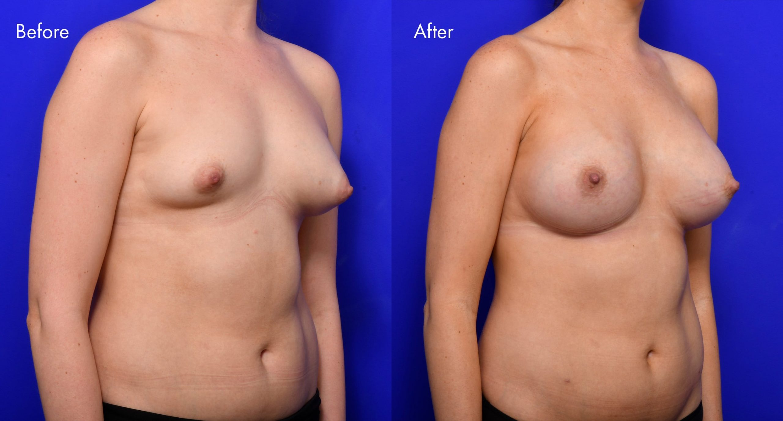 Tuberous Breasts Before and After | 3