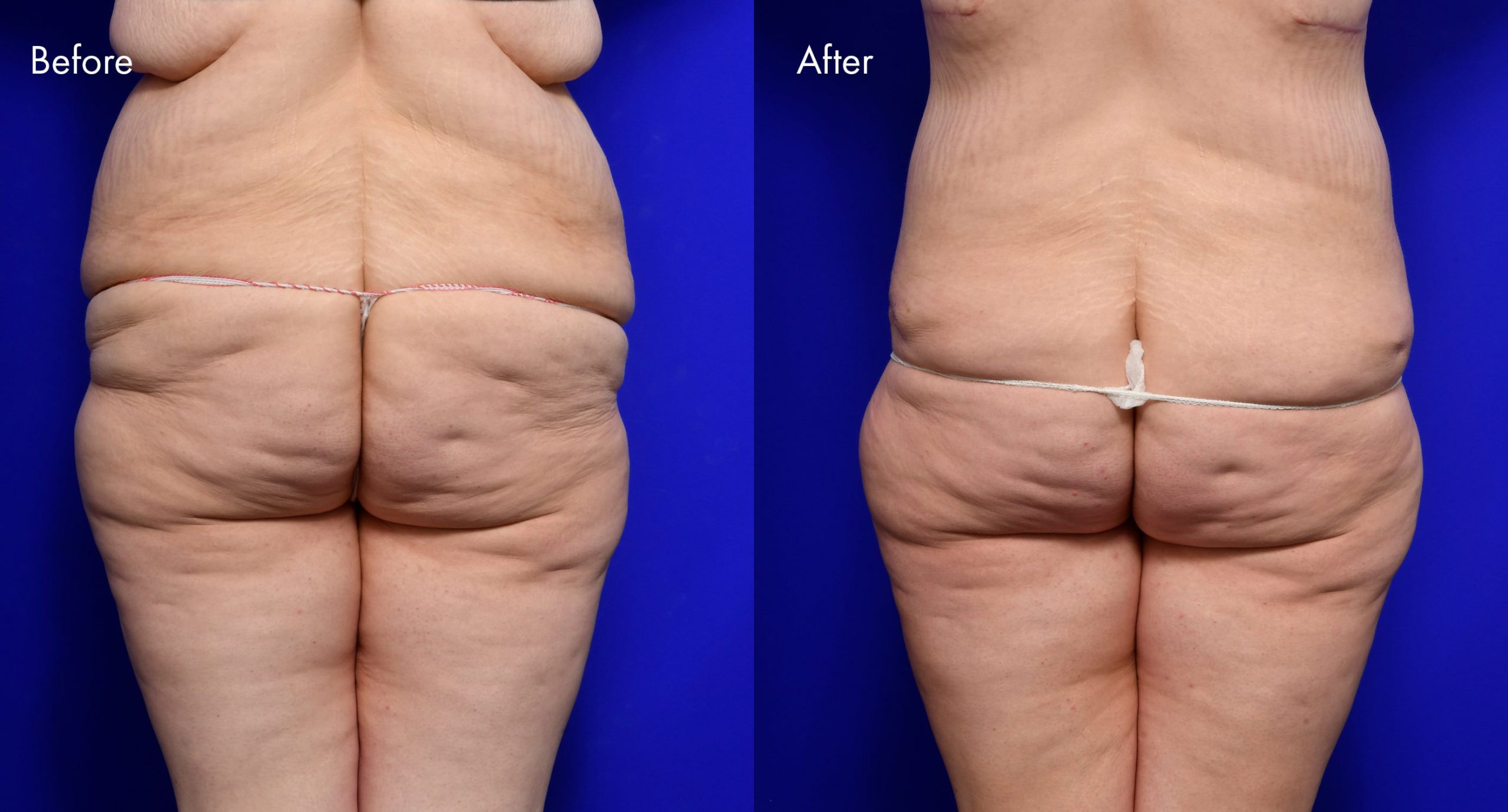 Tummy Tuck (Abdominoplasty) Before and After | 3
