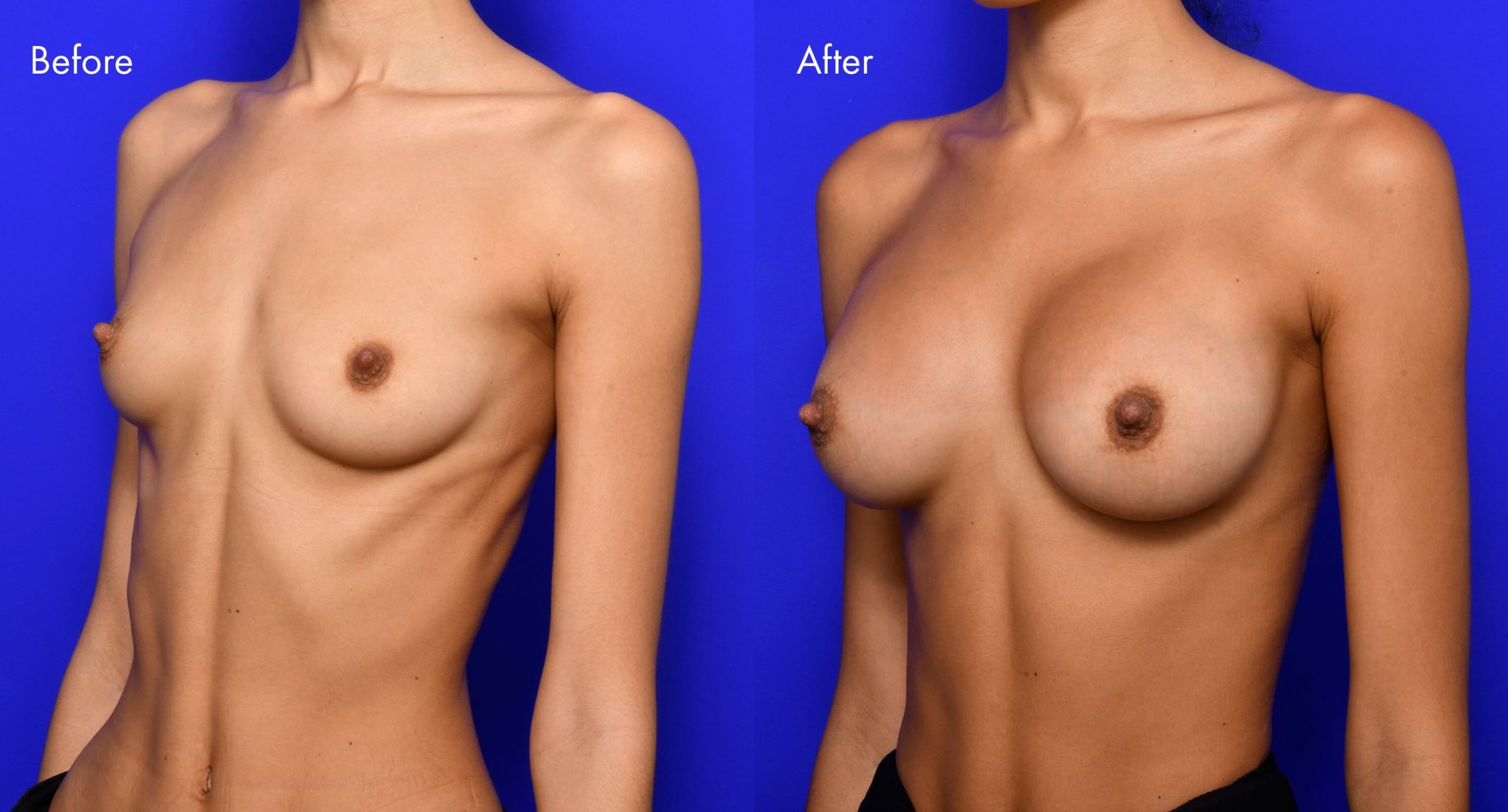 Breast Augmentation Before and After | 8