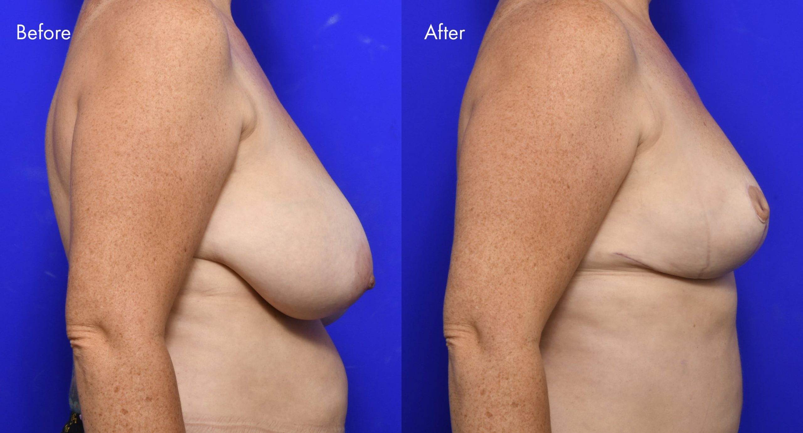 Breast Reduction Before and After | 9