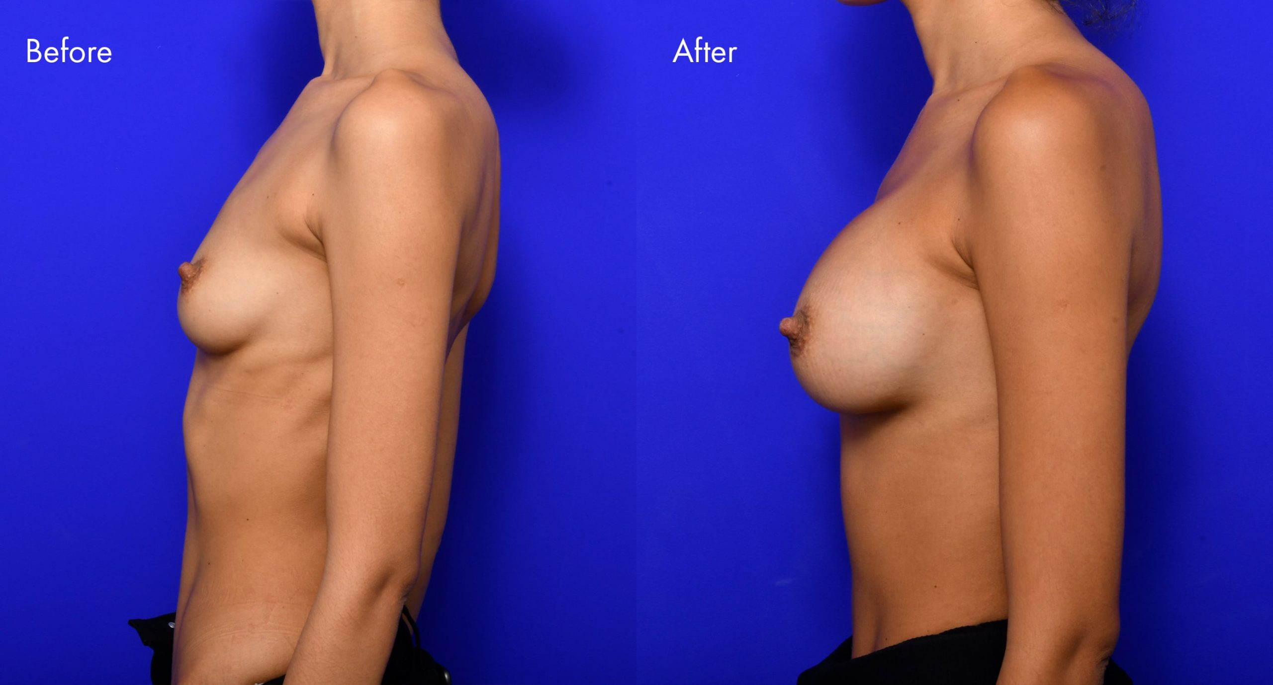 Breast Augmentation Before and After | 7