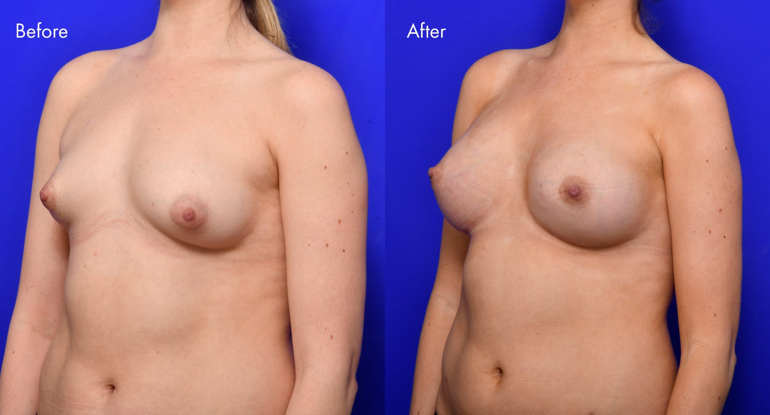 Tuberous Breasts Before and After | 5