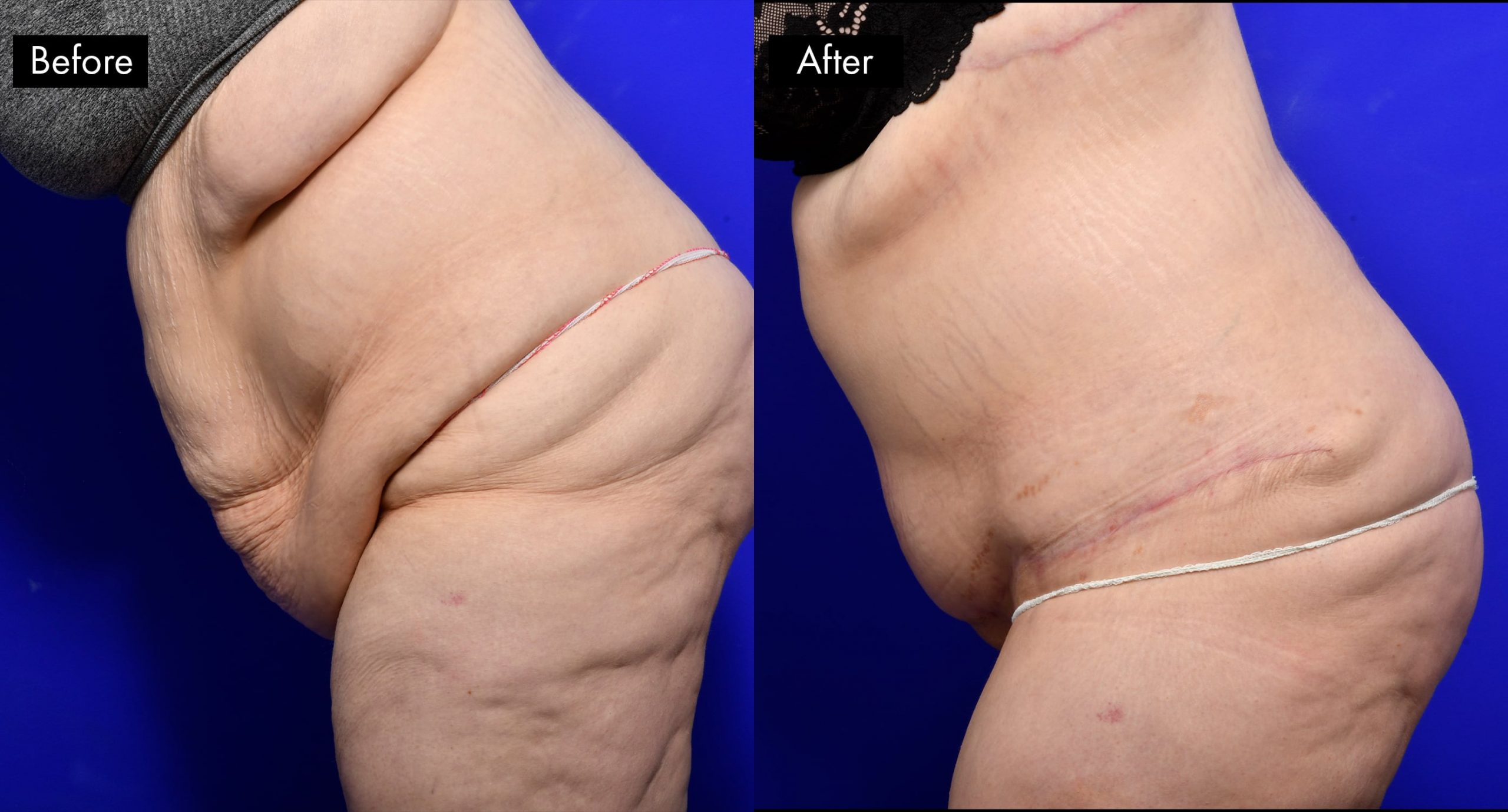Tummy Tuck (Abdominoplasty) Before and After | 5
