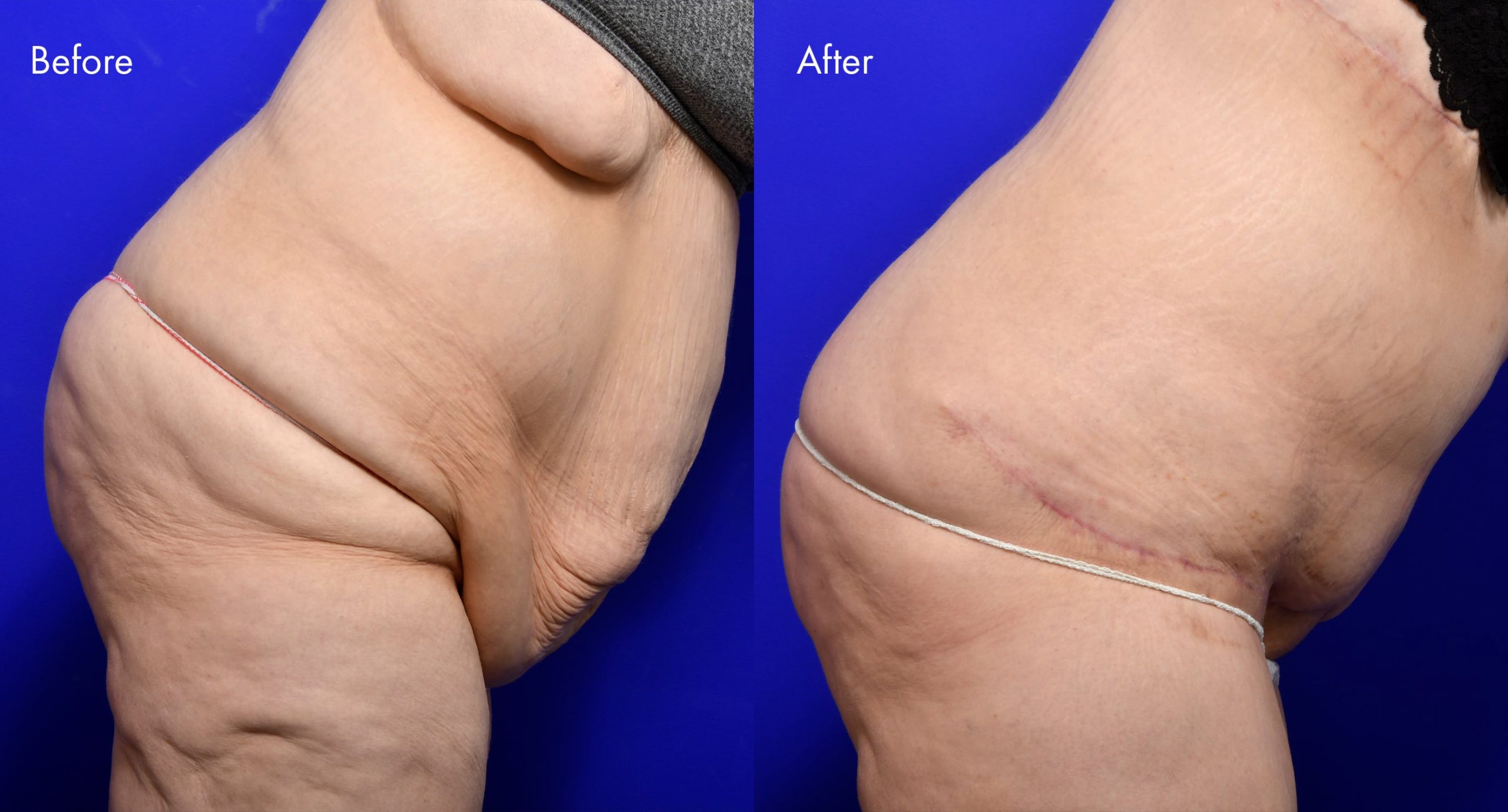 Tummy Tuck (Abdominoplasty) Before and After | 6