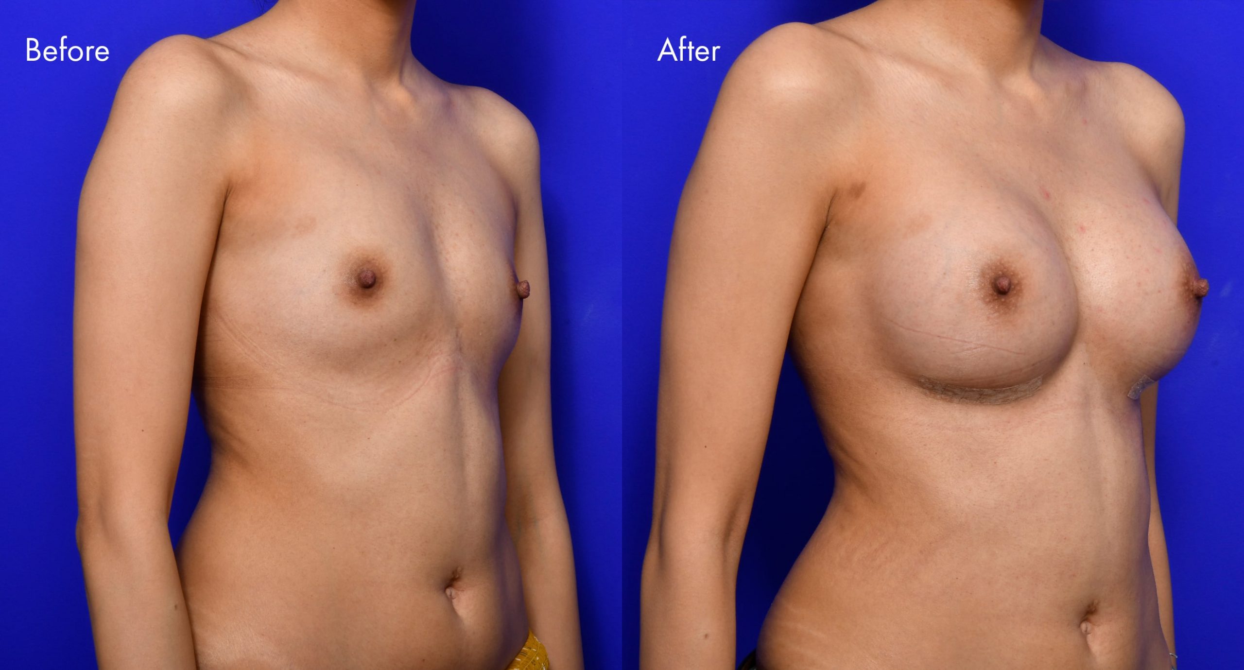 Breast Augmentation Before and After | 12