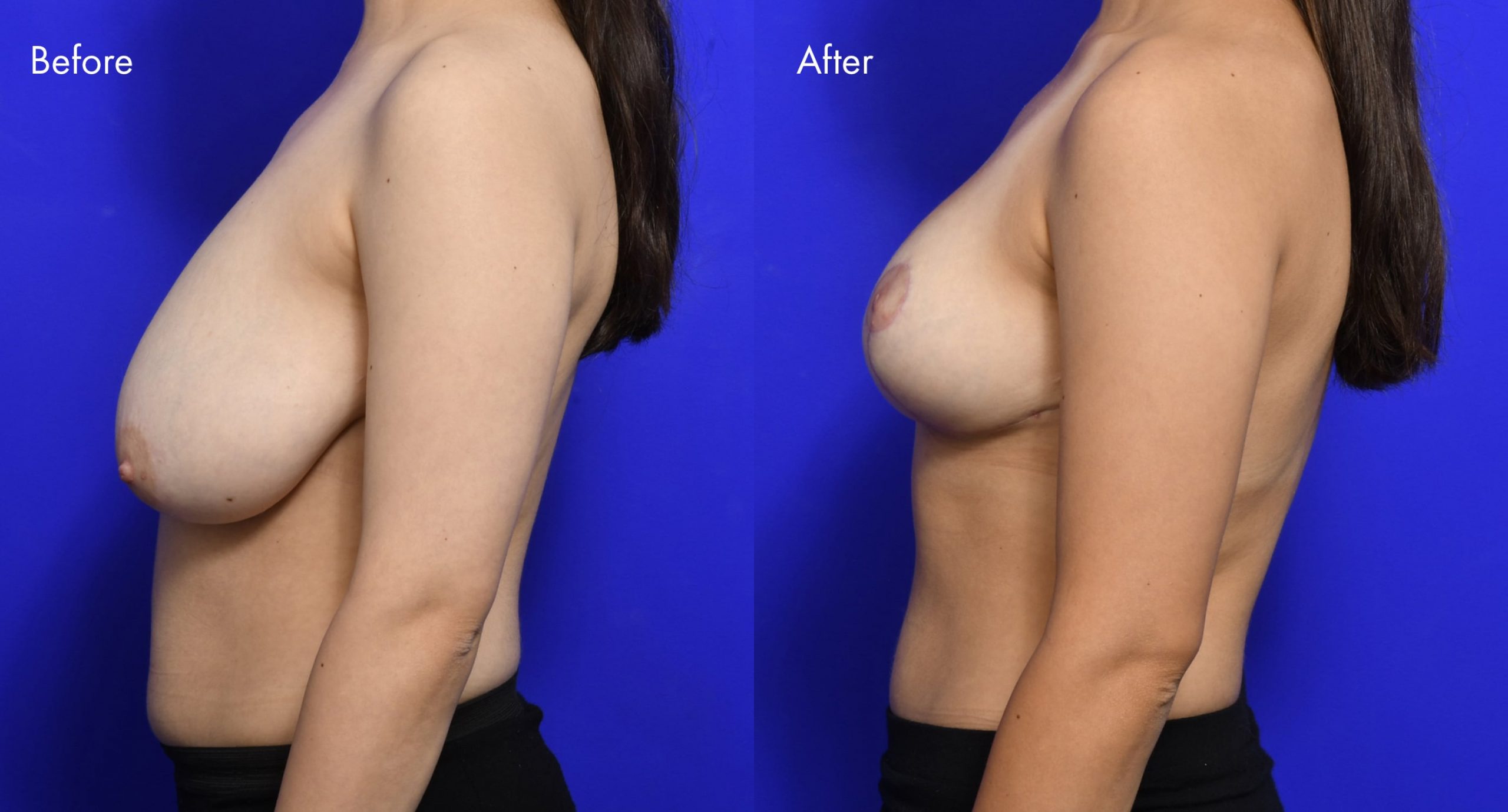 Breast Reduction Before and After | 4