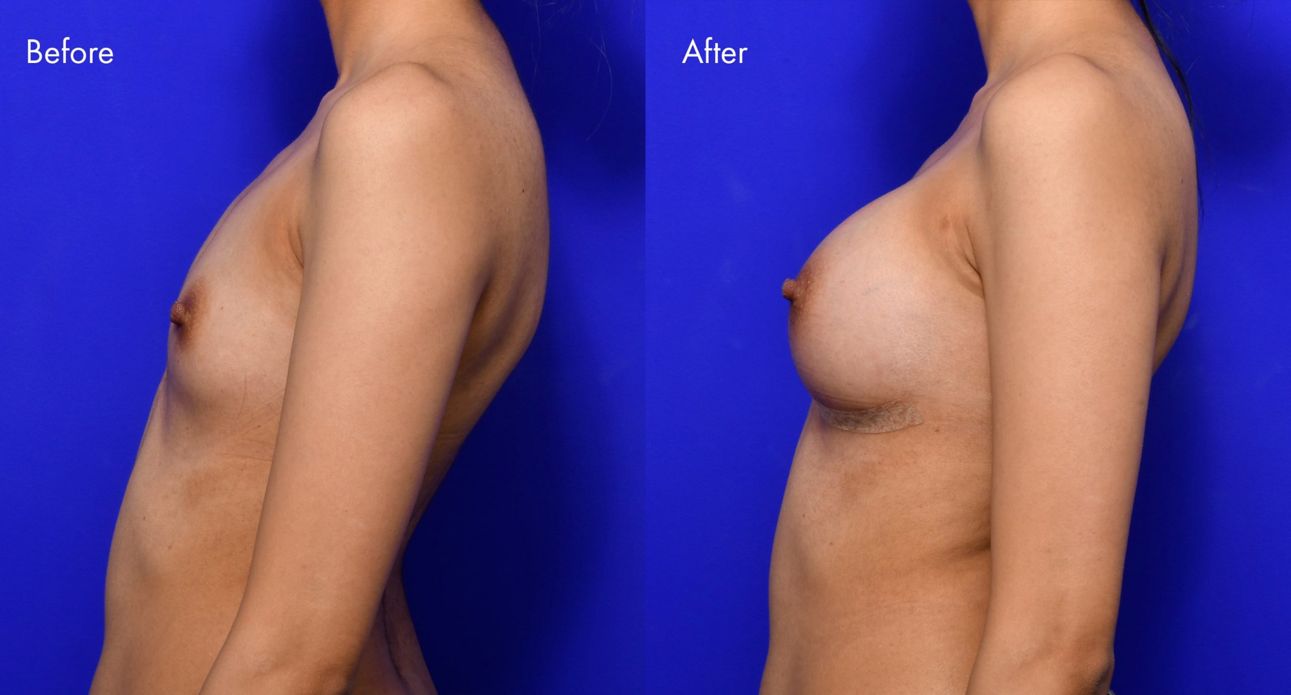Breast Augmentation Before and After | 15