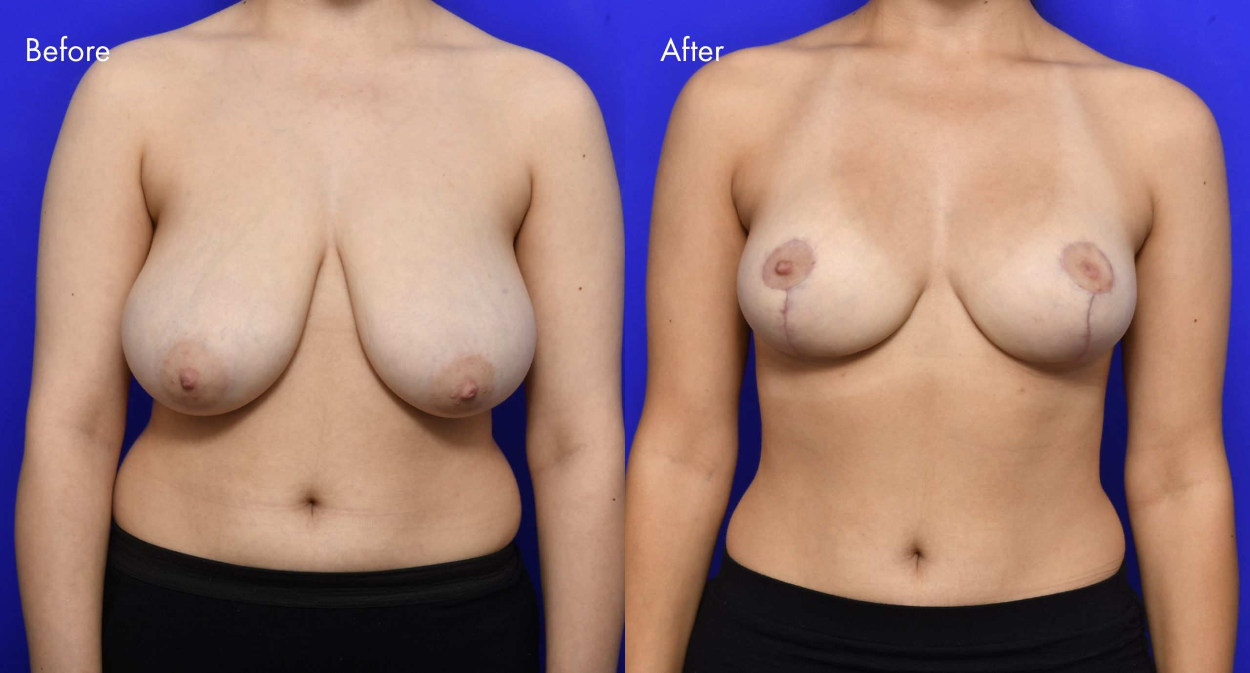 Breast Reduction Before and After | 3
