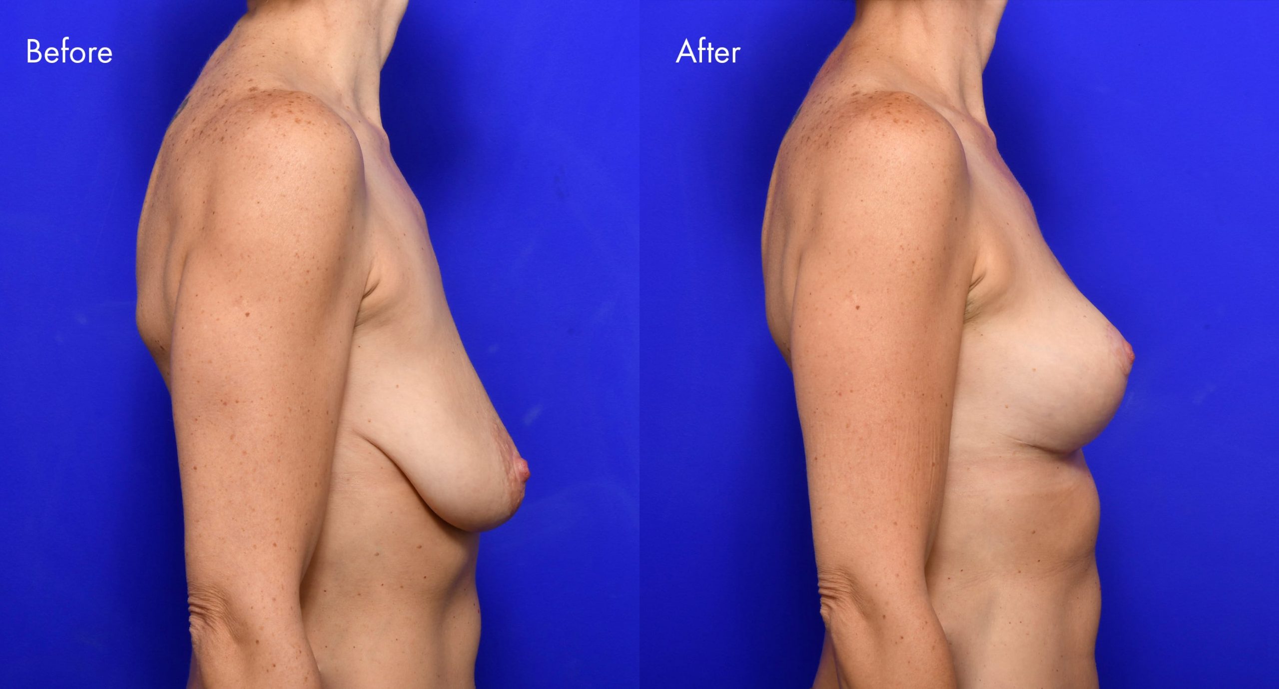 Breast Reduction Before and After | 2